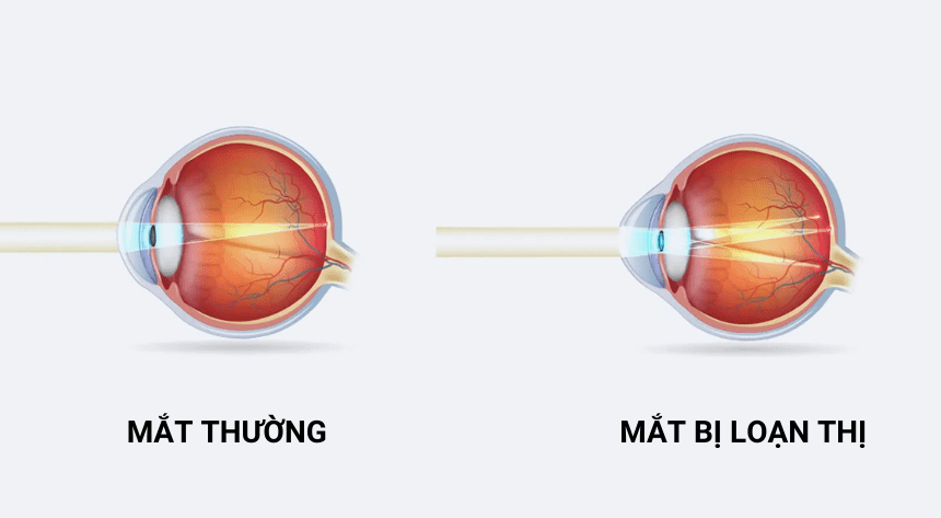 LOẠN THỊ: NHÌN MỜ, NHÌN NHOÈ CÓ PHẢI LÀ BỆNH? HIỂU ĐÚNG HƠN ĐỂ NHÌN RÕ HƠN!